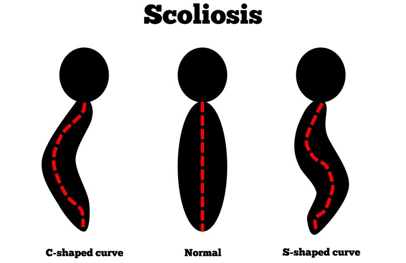 Sioux Falls, SD scoliosis treatment